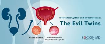 Image result for Interstitial Cystitis