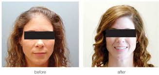 The Next Big Thing; Hair Restoration