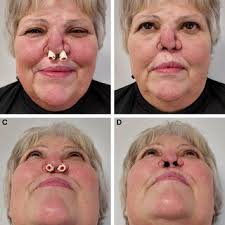 Case 3: The defect in the finger after debridement (A). An outline of...