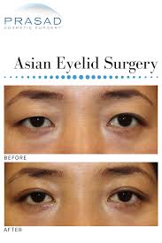 Asian Eyelid Surgery Eyelid Surgery Surgery Cosmetic Surgery