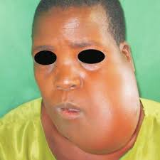 PDF) Late reporting for health care among patients presenting with oral  maxillofacial tumours or tumour- like lesions in Muhimbili National  Hospital, Tanzania