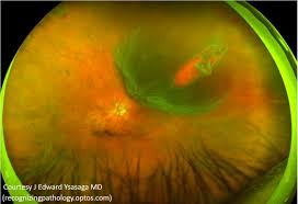 However, it more commonly occurs in people over 40. Retinal Detachment Vitreoretinal Surgery Hereford Eye Surgery