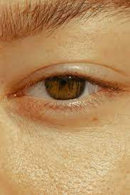 Why Is My Eyelid Twitching? Questions And Answers - The New York Times