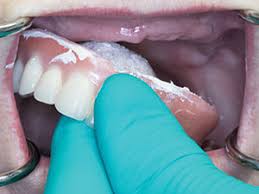 What are the different types of dentures? Application Of A Long Term Resilient Lining Material Dentistry Today