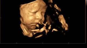 20 to 38 Week Ultrasound