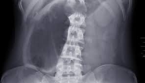 Image result for Volvulus