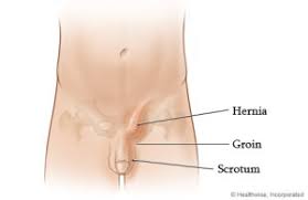 Image result for Inguinal hernia man