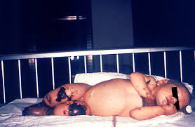 Meningococcemia also known as meningococcal septicemia or meningococcal bacteremia, is an acute (sudden onset) infection of the bloodstream and meningococcemia is a medical emergency. Meningokokkenkrankheiten Infektionskrankheiten Msd Manual Profi Ausgabe