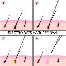 As you see, laser hair removal is way better than electrolysis hair removal. Treatments Proluma Electrolysis And Laser Hair Removal