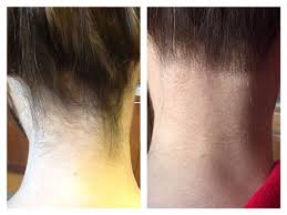 Laser back hair removal is the proven method for getting rid of unwanted back hair quickly and effectively. Laser Hair Removal Treatment In Metro Detroit Michigan Cosmetic Surgery