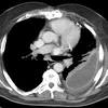 Pleural effusion symptoms include shortness of breath or trouble breathing, chest pain, cough, fever, or chills. 1