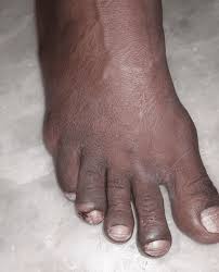 Image result for Paronychia feet