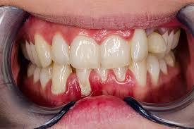 Image result for Gingivitis