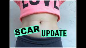 My Bellly Button Piercing Scar Update Vikamenabeauty Youtube