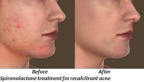 Their mechanism of action, effectiveness, and safety. Spironolactone Therapy Aventura Fl Recalcitrant Acne Treatment Aventura Fl