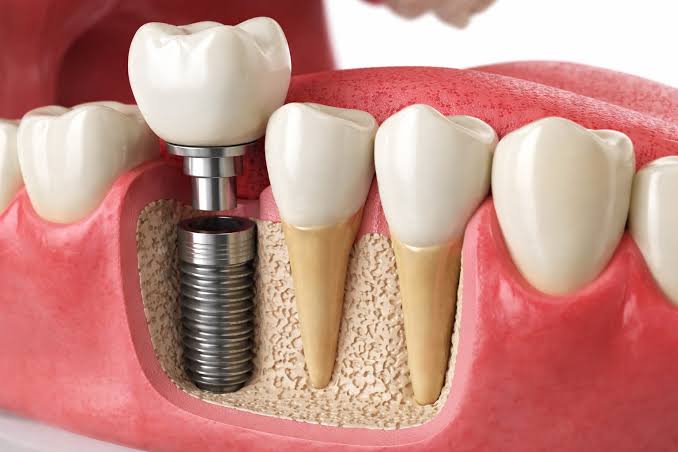 Dental Implants Types: Single, Basal, Zygomatic and Mini