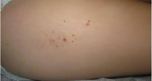 Dermatitis De Contacto Piel L Latinoamericana