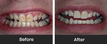 These two products work together to lift stains from teeth without being overly abrasive. Teeth Whitening London Uk S No 1 Clinic For Teeth Whitening