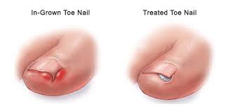 Maybe you would like to learn more about one of these? Ingrown Toenails What Are Ingrown Toenails Vascular Health Clinics