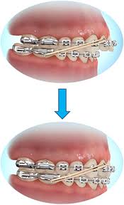 Patients requiring braces have different type of problems with different kind of intensity of the problem. Elastics Rubber Bands Olympus Pointe Orthodontics Garri Tsibel Dds