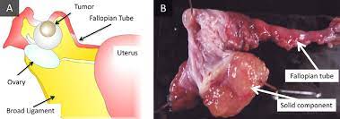 A fringe or fringelike margin or border , esp at the opening of the fallopian tubes | meaning, pronunciation, translations and examples. The Tumor Was Found Adjacent To The Fimbria Of The Fallopian Tube A Download Scientific Diagram