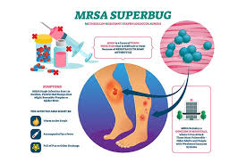 Most often, it causes mild infections on the skin, like sores, boils, or abscesses.but it can also cause more serious skin infections or. Mrsa In Children Causes Symptoms Treatment And Risks
