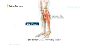 Image result for Shin Splints