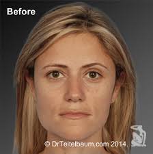 Rhinoplasty Before and After Photos by Steven Teitelbaum, MD; Santa Monica,  CA