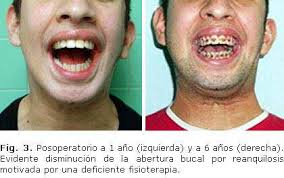 Redalyc.Tratamiento simultáneo de anquilosis temporomandibular unilateral  congénita y del microlaterognatismo asociado