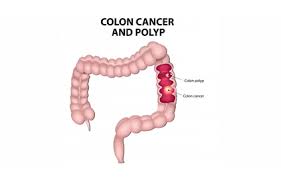 The recommended treatment options available for intestinal cancer may vary on many different factors as no two tumours are the same. Colorectal Cancer Symptoms Prevention And Treatment Dr Antonio