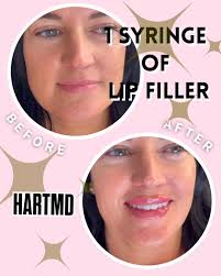 One syringe is all it takes for a beautiful transformation 💉, It’s insane  how a little volume can completely feminize and balance the face — no  filter, just filler. 💋✨, 📍 Goodyear, Arizona