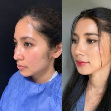 Ethnic Nose By Drboraok