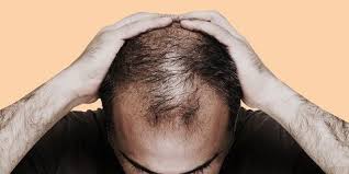 As soon as you relax and the stress stops, your hair will resume its normal growth cycle. Stress Related Hair Loss How It Happens And Solutions