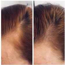 Explore hair loss treatments for male pattern baldness (androgenetic alopecia), a condition 2/3 of men will experience by age 35. Smp Abbie G Award Winning Freelance Makeup Artist