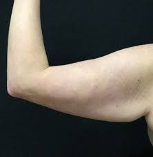 Average cost ranges from $4,000 to $7,000 with a board certified plastic surgeon. Arm Lift Surgery Brachioplasty Dr David Sharp