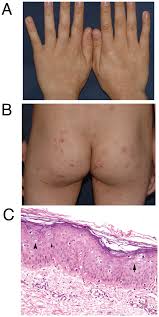 Image result for human papillomavirus symptoms