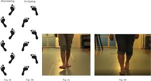 Image result for In-Toeing