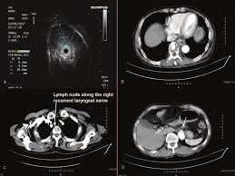 Throat cancer that has spread to distant parts of the body (metastatic cancer), leads to specific symptoms depending on the location a biopsy involves the removal of tissue to look for any cancerous cells. A By Endoscopic Ultrasound The Esophageal Tumor Was Staged As T3n1 Download Scientific Diagram