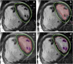 Für die filterung wurden keine ergebnisse gefunden! Implications Of Cardiac Variability With Cardiovascular Magnetic Resonance Imaging For Calculating Trial Sample Size In Pulmonary Arterial Hypertension International Journal Of Cardiology