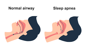 What is Sleep Apnea? - Hughes Family Dental