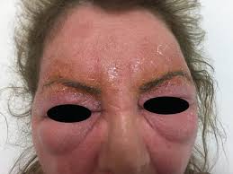 Pseudoangioedema Intechopen