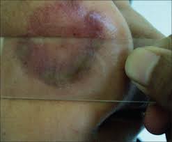 Image result for Diascopy