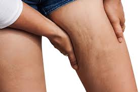 Der taillentwist ist eine der effektivsten übungen für die seitlichen bauchmuskeln. Anti Cellulite Workout 7 Ubungen Um Cellulite Zu Reduzieren