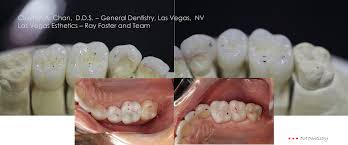 Suffoletta provides dental implant, dental crown, laser dentistry & no pain general dentistry. Clayton A Chan Dds Las Vegas Cosmetic Dentistry Occlusion Connections 10 Occlusion Connections
