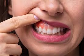 home remes to reduce gum swelling