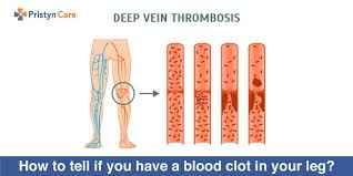 Other treatment procedures for blood clot in legs include physical exercises and use of vena cava filters. How To Tell If You Have A Blood Clot In Your Leg Warning Signs And Remedies Pristyn Care