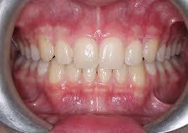However, if the condition persists, it may indicate a more serious problem developing. Gum Recession In Orthodontics Black Triangles Orthodontist Vaughan Braces Vaughan Invisalign Vaughan