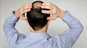 Is There A Cure For Male Pattern Baldness Elithairtransplant