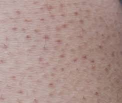 Image result for Keratosis pilaris