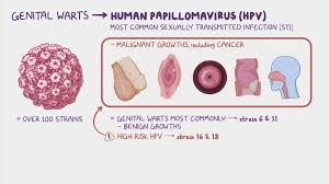 Image result for genital warts